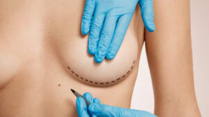 How long does a breast lift last?