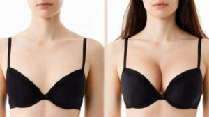 downside of breast lift surgery?