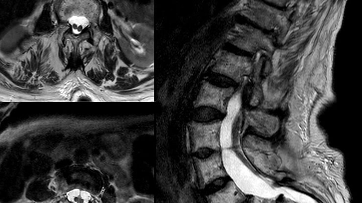 Diastematomyelia Type 1
