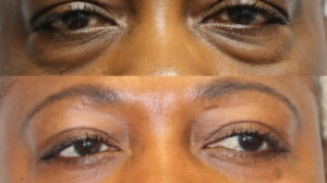 eyelid surgery cost in South Africa