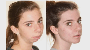 Jaw Surgery