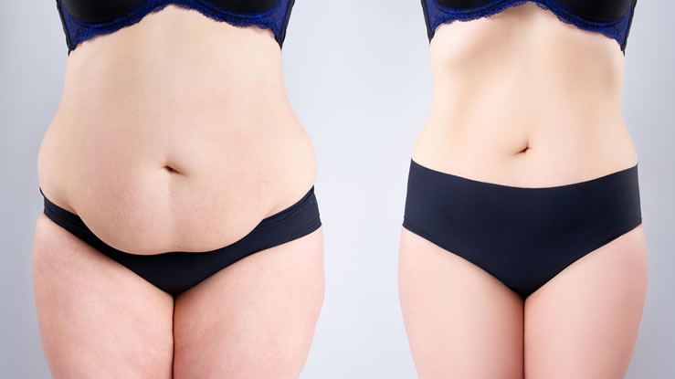 abdominoplasty