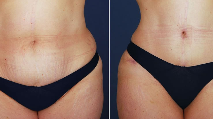 tummy tuck and an abdominoplasty
