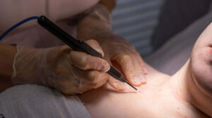 Is skin tag cauterization painful