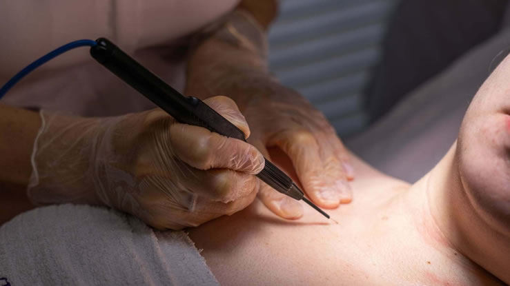 Is skin tag cauterization painful