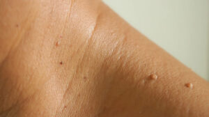 remove Skin Tags with Radiocautery