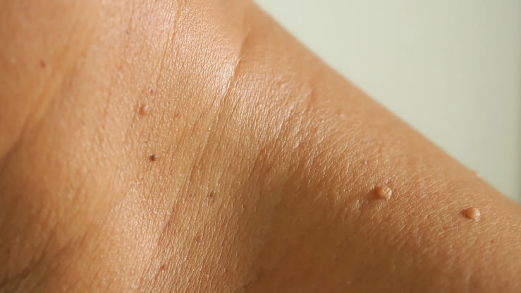 remove Skin Tags with Radiocautery