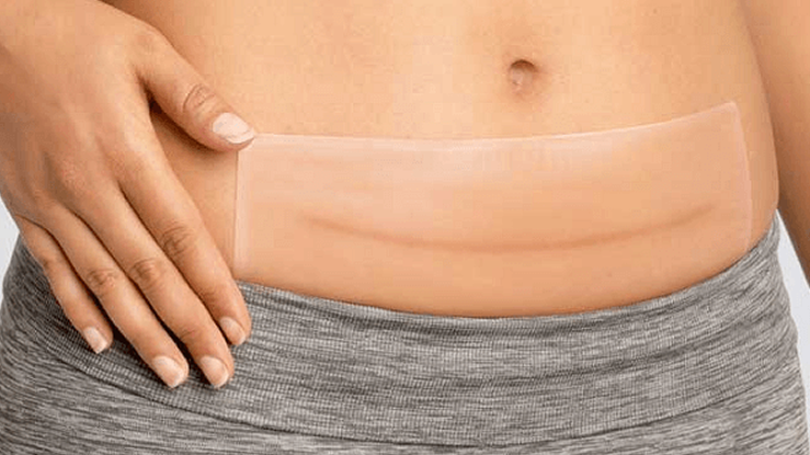 silicone scar sheets