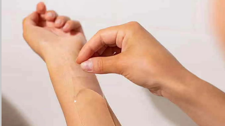 silicone scar sheets