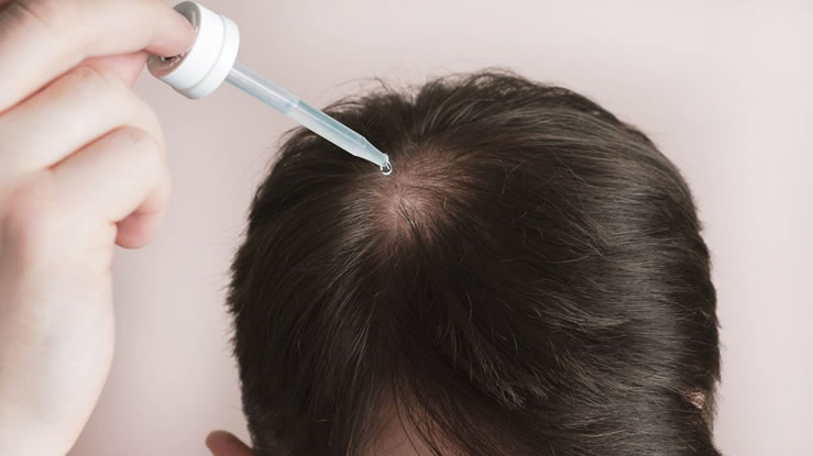 topical minoxidil