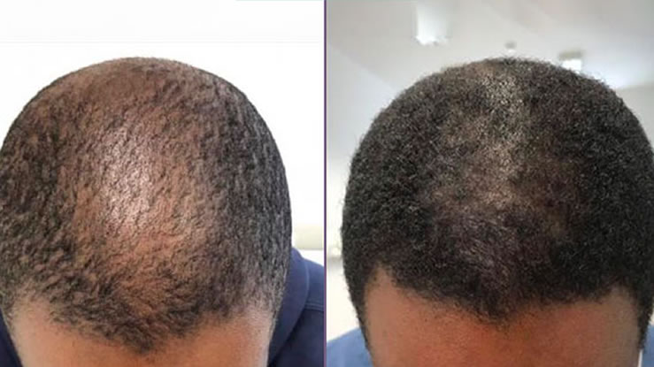 30-Day Post-Transplant Care Plan with Calecim Professional for Optimal Hair Recovery