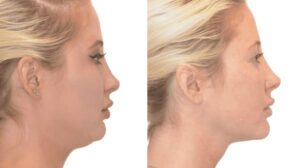Chin Liposuction