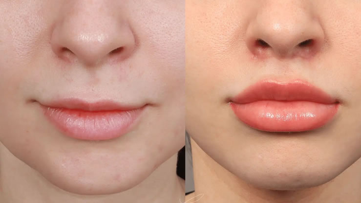 Lip filler cost in the USA