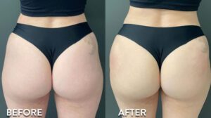 Non surgical BBL options