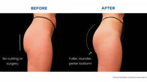 Non-surgical BBL options