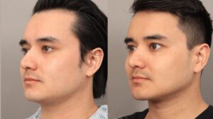 average chin liposuction cost