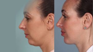 chin liposuction cost usa