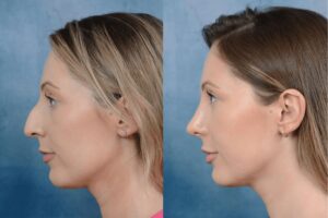 Rhinoplasty