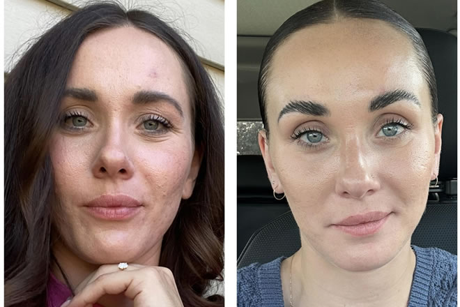 Tretinoin use after a year